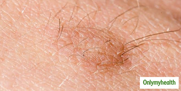 Want To Know The Types And Causes Of A Mole? Dr Sukriti Sharma Talks ...